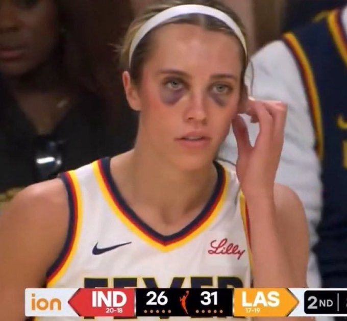 強度趕上CBA！??WNBA狂熱前鋒赫爾被“打成熊貓”了